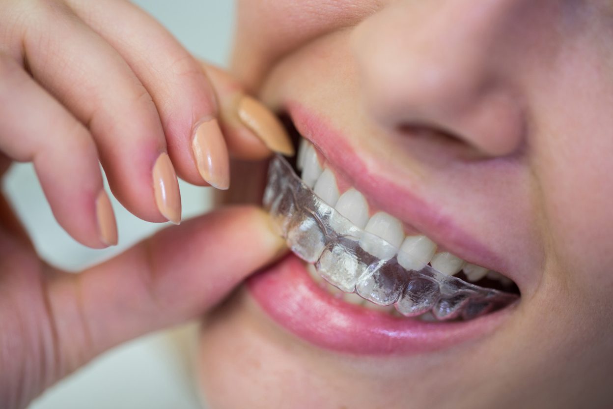 Close-up of a clear aligner being put in